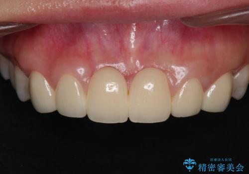 前歯 ブリッジ周囲の腫れた歯ぐきを改善の症例 治療前