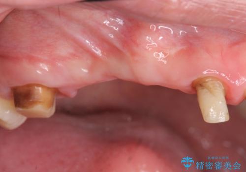 虫歯による多数歯欠損　インプラント咬合機能回復の治療前