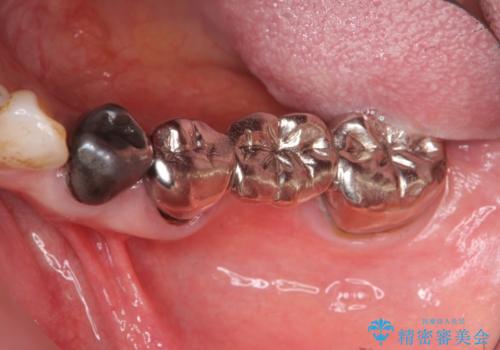 [奥歯のセラミック治療] 銀歯のブリッジを白くの治療前