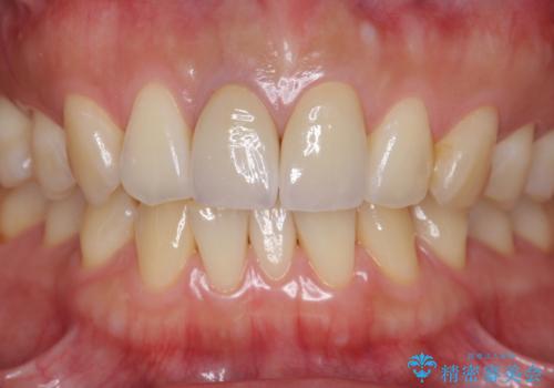 前歯の変色 根管治療と高品質セラミック歯科治療の治療後