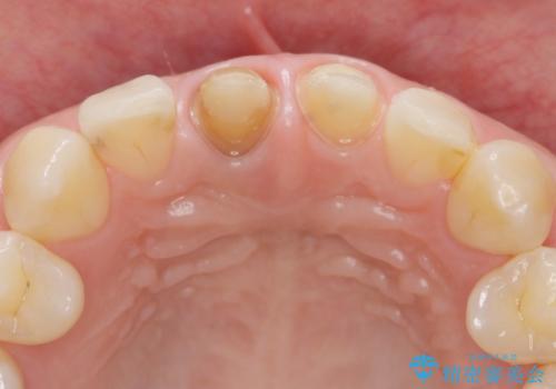 前歯の変色 根管治療と高品質セラミック歯科治療の治療中