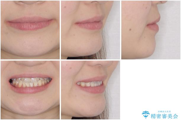 前歯のデコボコを治したい インビザラインによる矯正治療の治療前(顔貌)