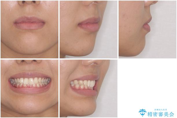 ディープバイトと前歯のデコボコを治したい インビザラインによる矯正治療の治療前(顔貌)