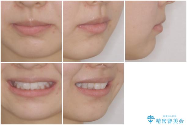 矯正治療の後戻り インビザラインによる再矯正治療の治療前(顔貌)