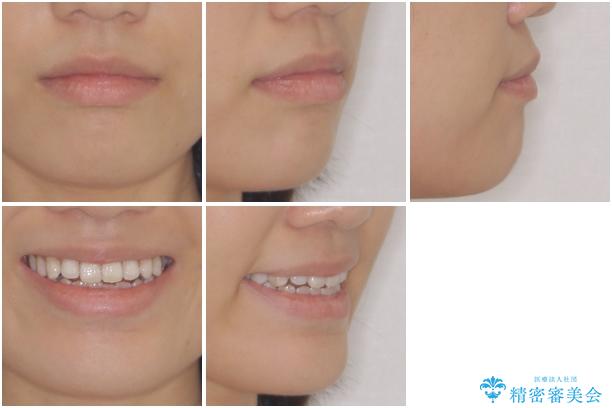 話しにくいオープンバイト インビザラインによる矯正治療の治療前(顔貌)
