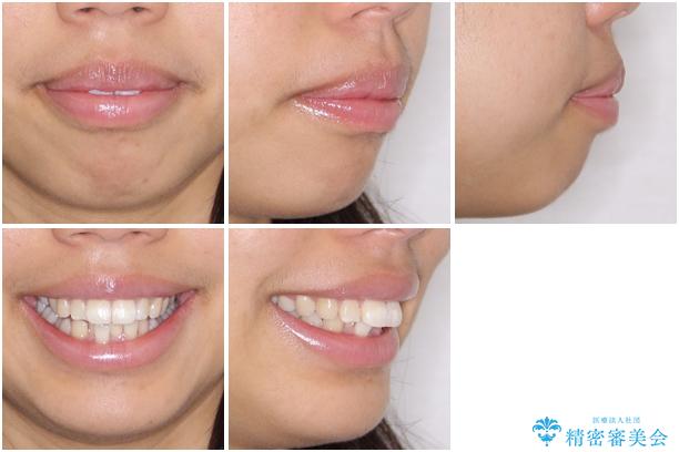 口が閉じられない 抜歯矯正で口元をスッキリとの治療前(顔貌)