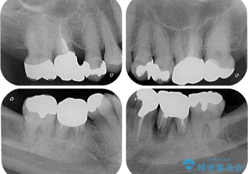 金属を全てセラミックに メタルフリー治療の治療前