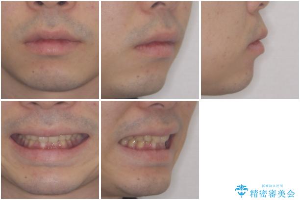 深い咬み合わせと前歯のデコボコの改善　インビザラインによる矯正治療の治療前（顔貌）