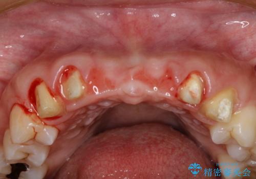 前歯　ブリッジ周囲の腫れた歯ぐきを改善