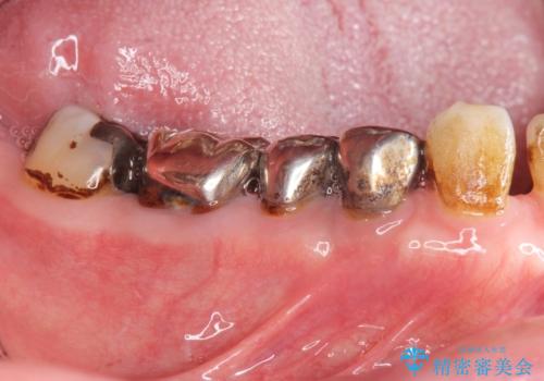 大臼歯 再根管治療の治療前