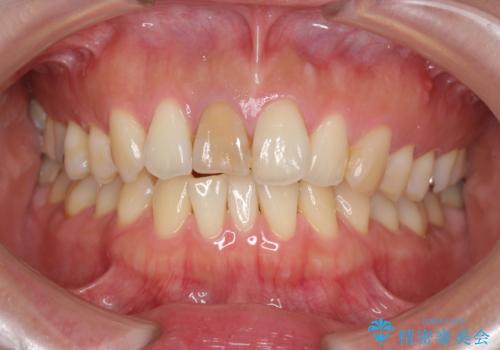 前歯の変色 根管治療と高品質セラミック歯科治療の治療前