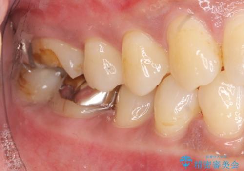 目立つ銀歯を白くしたいの治療前