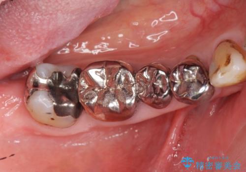 大臼歯 再根管治療の治療前