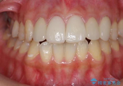 不適合なクラウンのやりかえの治療前