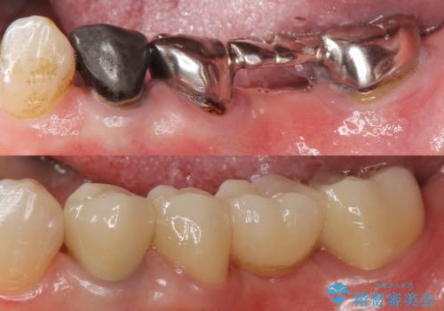 [奥歯のセラミック治療] 銀歯のブリッジを白く