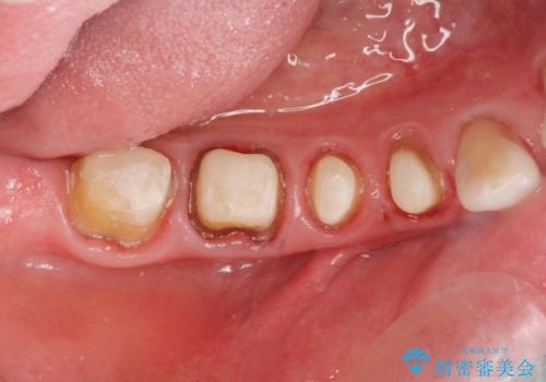 大臼歯 再根管治療の治療中