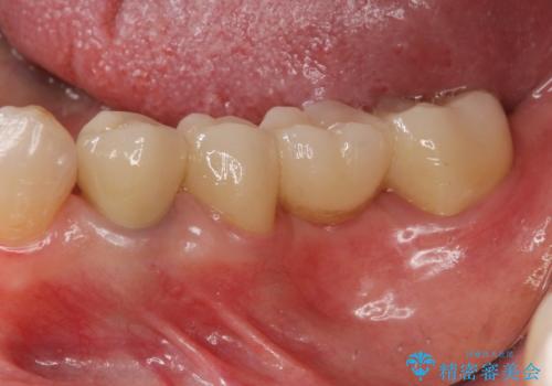 [奥歯のセラミック治療] 銀歯のブリッジを白くの症例 治療後