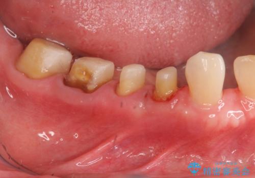 大臼歯 再根管治療の治療中