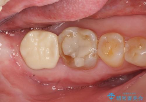 歯ぎしりによる異常に低い歯冠高径 歯周外科による解決の治療後