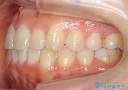 上下の前歯のがたつき　歯を抜かずに矯正の治療後
