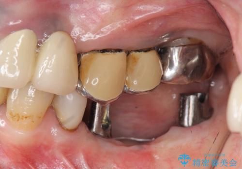 インプラントで咬合機能を取り戻すの治療中