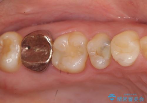 [フルジルコニアクラウン] 老朽化した銀歯を白くの症例 治療前