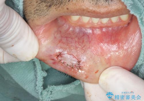唇を噛んでしまった 粘液嚢胞の摘出の治療中