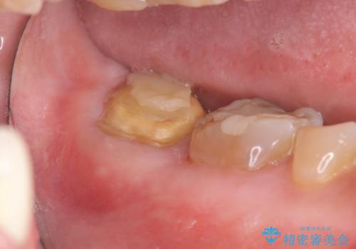 歯ぎしりによる異常に低い歯冠高径 　歯周外科による解決の症例 治療前