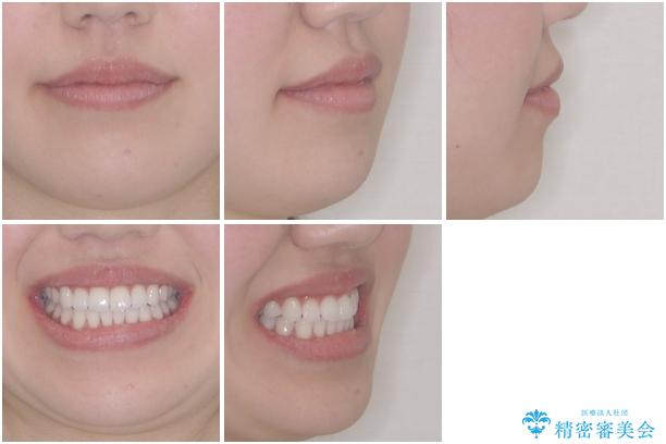 留学前に矯正治療 目立たないワイヤー装置でのスピード矯正の治療後(顔貌)