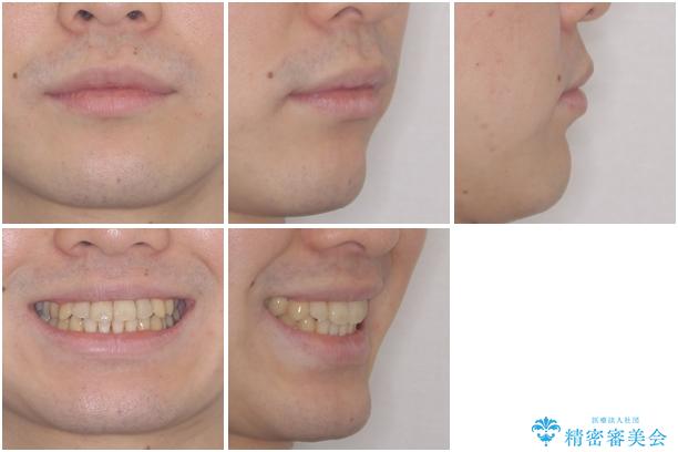 前歯のクロスバイト　インビザラインによる矯正治療の治療後（顔貌）