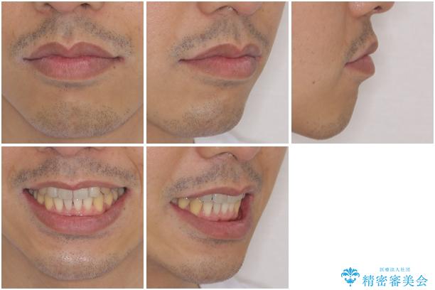 矯正歯科治療と前歯の歯肉移植術の治療後（顔貌）