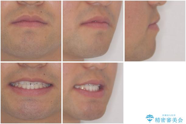 美容歯科でも断られた　著しい前歯のクロスバイトをワイヤー矯正で改善の治療後（顔貌）