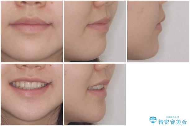 乳歯が残っている 目立たない装置での抜歯矯正の治療後(顔貌)