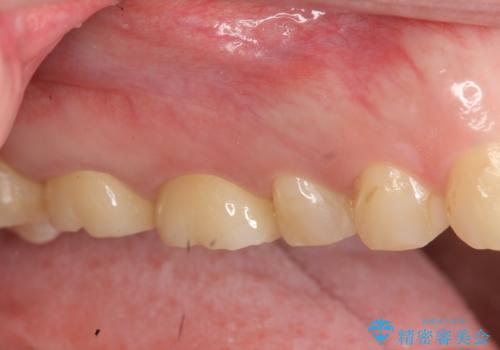 [フルジルコニアクラウン] 老朽化した銀歯を白くの治療後