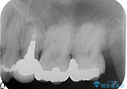 根管治療からのセラミック治療の治療前