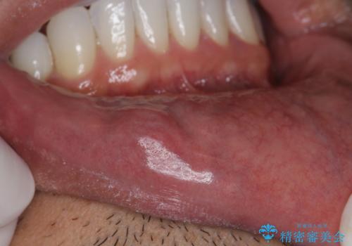 唇を噛んでしまった 粘液嚢胞の摘出の治療前