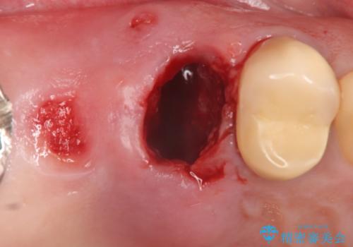 インプラント(ストローマン) 抜歯後の欠損補綴の治療中