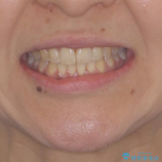 インビザラインによる狭窄歯列の拡大矯正　の治療後（顔貌）