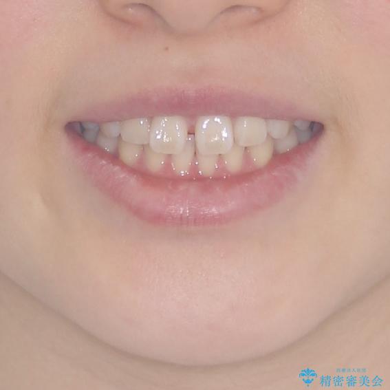 インビザラインによるすきっ歯の改善の治療前（顔貌）