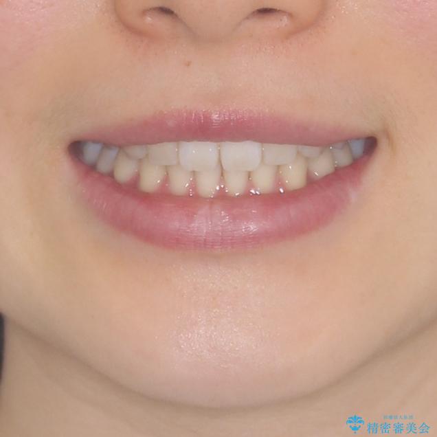 インビザラインによるすきっ歯の改善の治療後（顔貌）