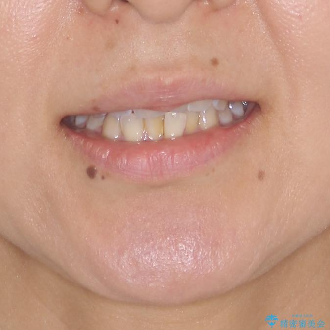 インビザラインによる狭窄歯列の拡大矯正　の治療前（顔貌）