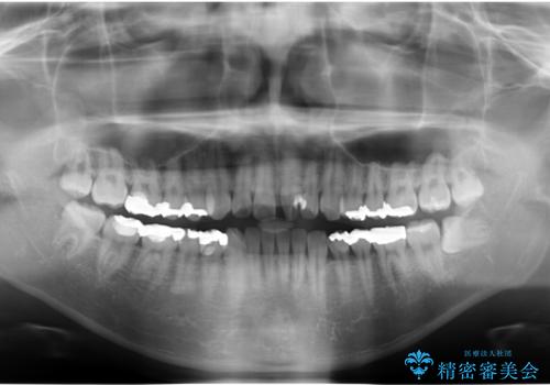 前歯のねじれ 上だけ部分矯正でコストダウンの治療前
