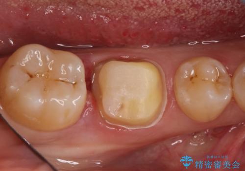 奥歯が痛い。根管治療~オールセラミッククラウンの治療中