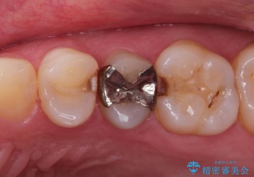 昔の詰め物のなかで広がる虫歯。セラミックインレーの治療前