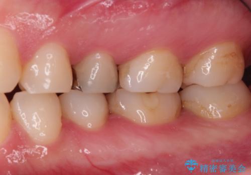 昔の詰め物のなかで広がる虫歯。セラミックインレーの治療前