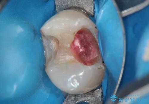 昔の詰め物のなかで広がる虫歯。セラミックインレーの治療中