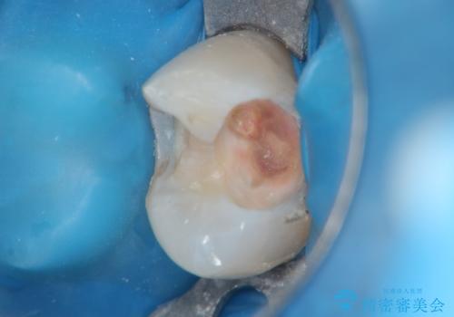 昔の詰め物のなかで広がる虫歯。セラミックインレーの治療中