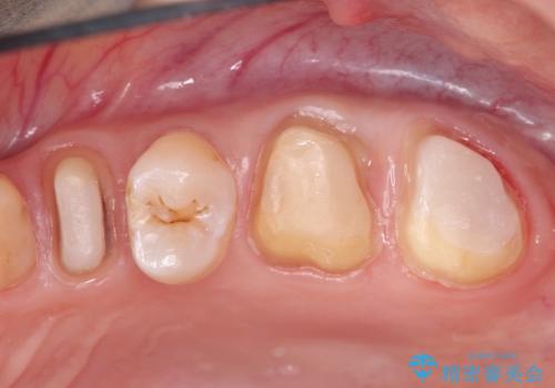 他院による虫歯治療(ドックスベストセメント)の再治療の治療中