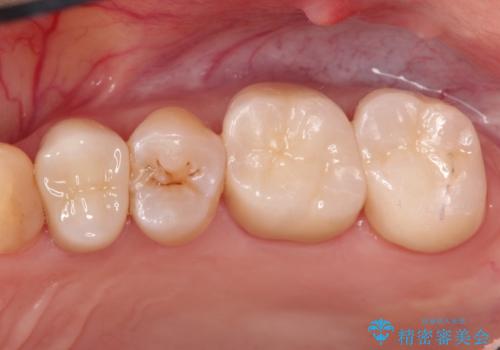 他院による虫歯治療(ドックスベストセメント)の再治療の治療後