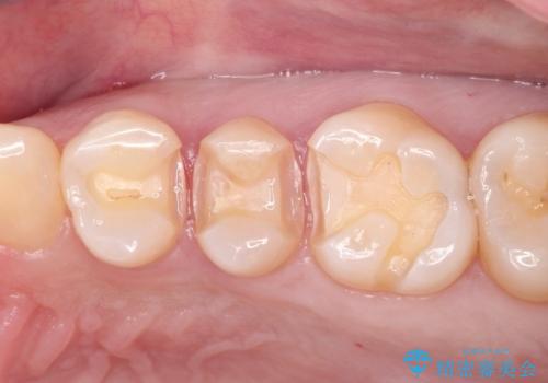 昔の詰め物のなかで広がる虫歯。セラミックインレーの治療中